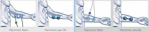 placement electrodes-tennis elbow tendinopathie du coude